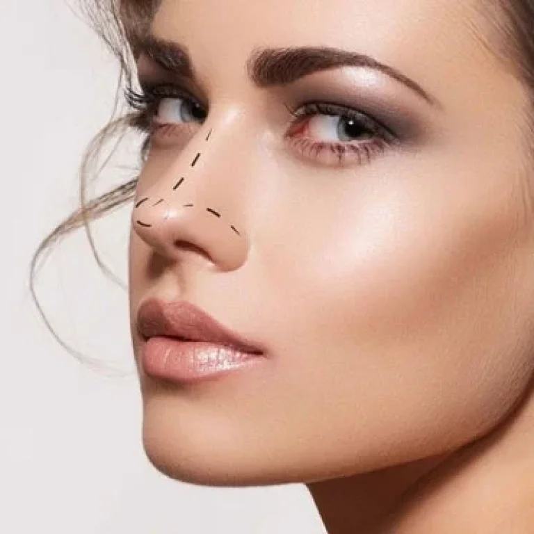 koruyucu-rinoplasti-ile-secili-hastalarda-mukemmel-sonuc-7