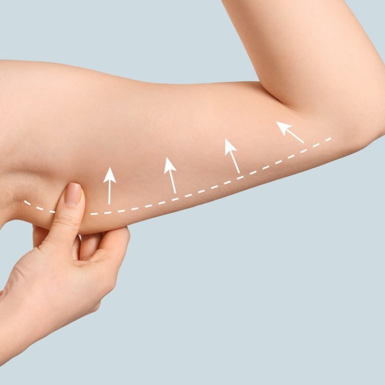 Arm of young woman after slimming on light background. Plastic surgery concept